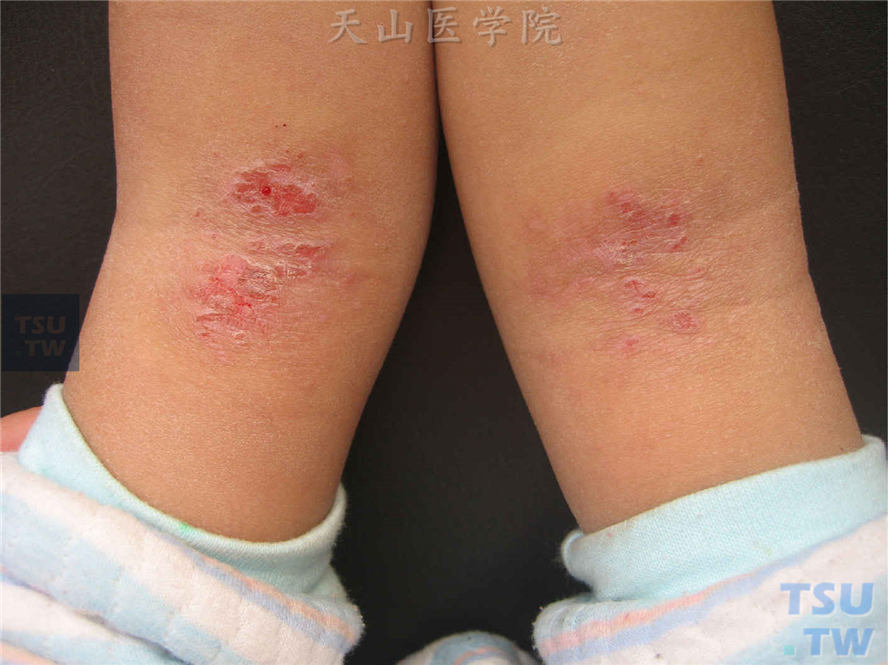 特应性皮炎（atopic dermatitis）的症状表现