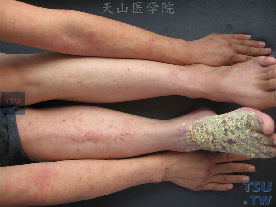 足外伤并发感染后发生，四肢对称分布红斑、丘疹，瘙痒剧烈