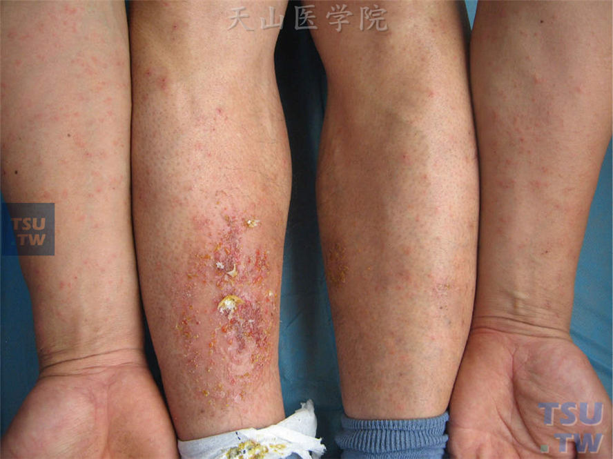 小腿湿疹基础上发生四肢对称分布瘙痒性红斑、丘疹