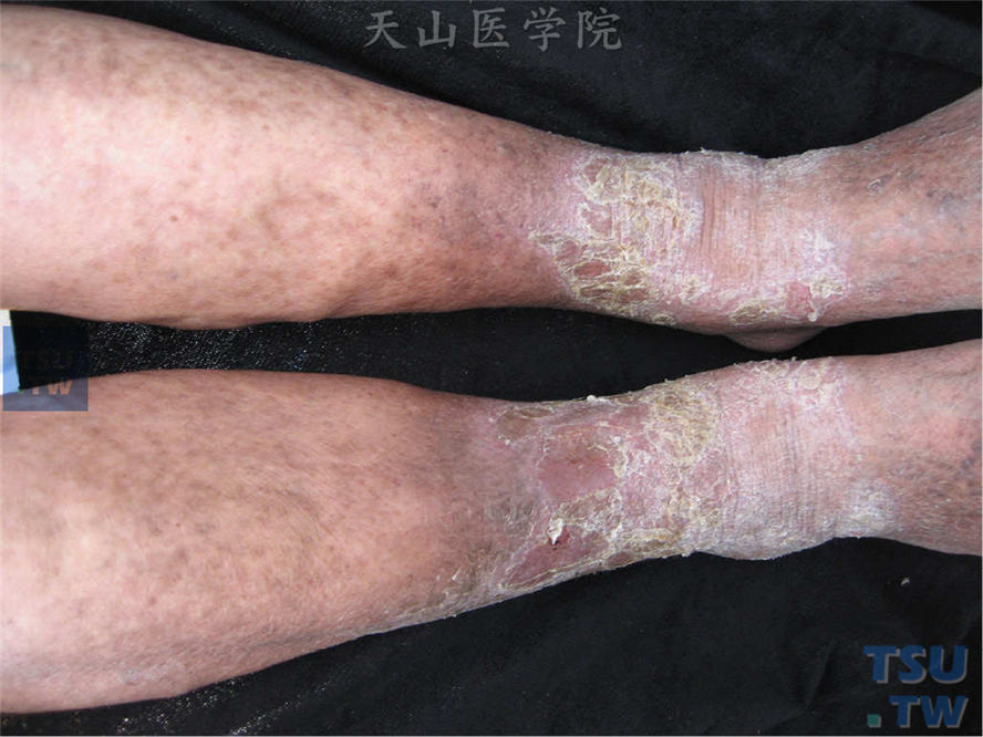 淤积性皮炎（stasis dermatitis）的症状表现