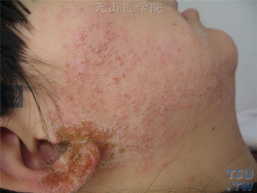 耳部湿疹皮损表面渗液、分泌物刺激周围皮肤潮红，其上丘疹、丘疱疹、糜烂、渗液、结痂