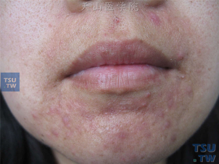 口周红斑、散在小丘疹，皮损与唇红缘之间可见正常皮肤