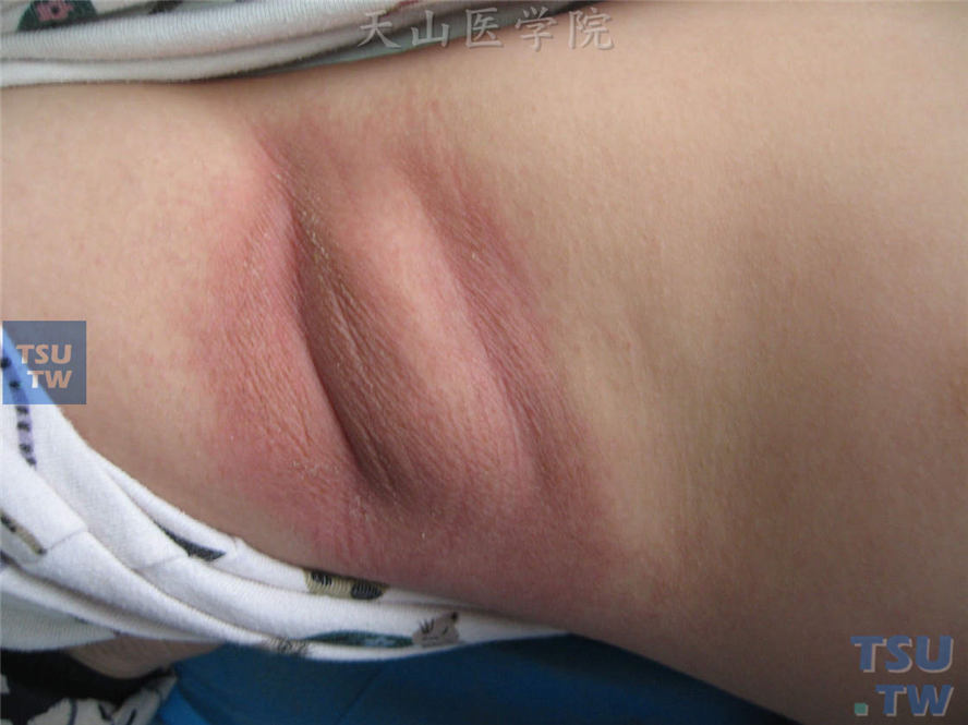 狒狒综合征（baboon syndroms）：发生于股内侧、阴囊、腹股沟，皮损为紫红色至淡红斑，边界清楚。该患者口服克拉霉素后发生右腋下边界清楚红斑