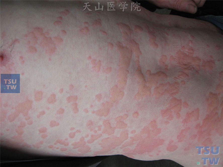 荨麻疹（urticaria）的症状表现