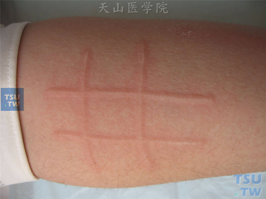 人工荨麻疹：亦称皮肤划痕症。用手或钝器划过皮肤后，沿划痕出现条状隆起，伴有瘙痒，不久可自行消退