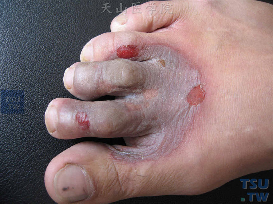 足趾圆形紫红斑，表面松弛性水疱，糜烂