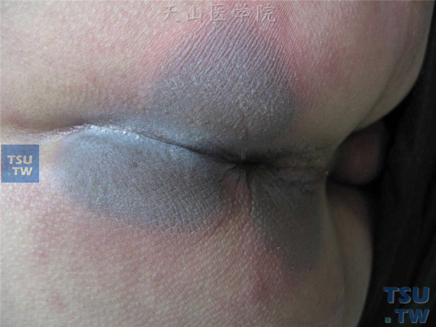 固定型药疹发生在肛周部位，中央为紫灰色，周边淡红色