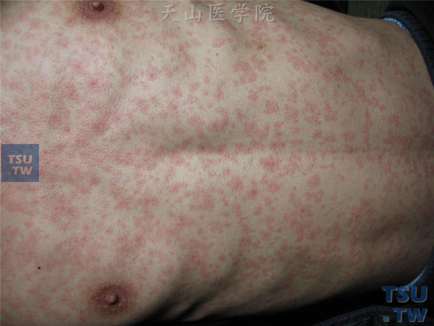 麻疹型药疹的症状表现