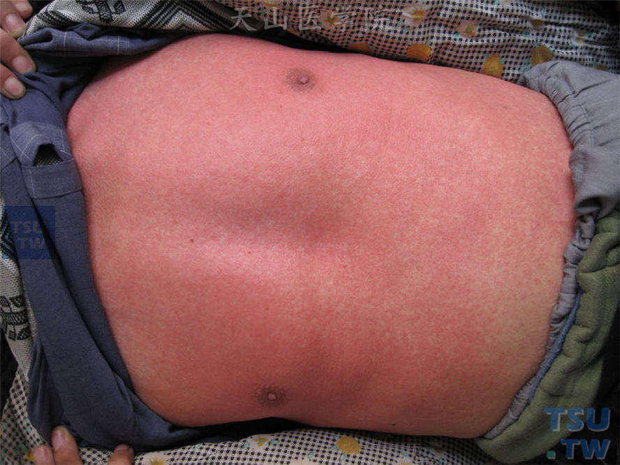 胸腹部猩红热样皮疹表现为弥漫性潮红