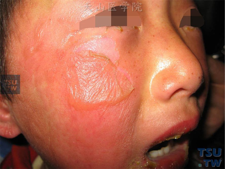 同一病人，面部红色斑片，松弛性水疱，因按压下眼睑时形成的糜烂面，尼氏征阳性