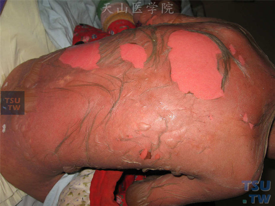 同一病人，72小时后，弥漫性紫红色斑片，有大小不等的松弛性水疱，尼氏征阳性，大片表皮坏死剥脱，露出糜烂面，类似烧伤