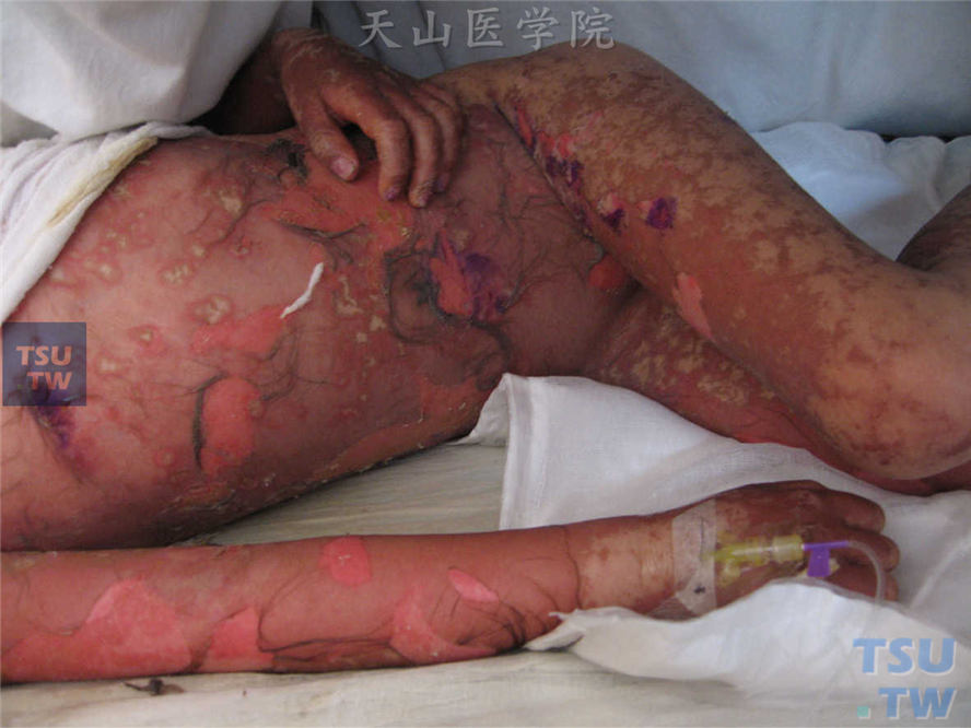 同一病人，弥漫性紫红色斑片，因继发细菌感染出现脓疱，大片表皮坏死剥脱，露出糜烂面，类似烧伤
