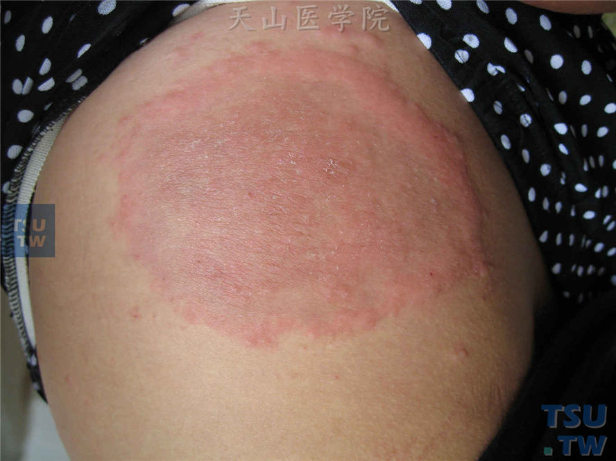 臀部肌注黄体酮20天发生边缘清楚的水肿性红斑
