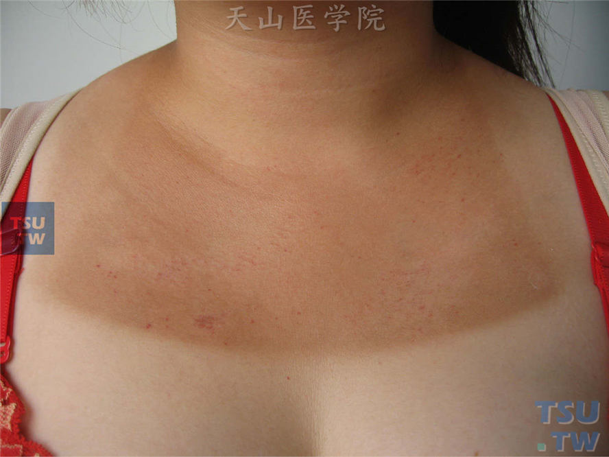 前胸上部暴露部位发生日晒伤后褐红色斑疹，表面点状抓痕