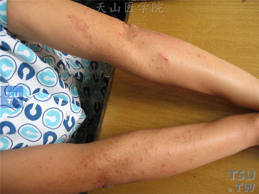 双上肢伸侧对称分布红斑、丘疹、丘疱疹，搔抓后表面结痂