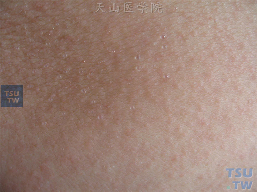 白痱：躯干密集分布针尖大小浅表透明水疱，基底及周围皮肤无发红