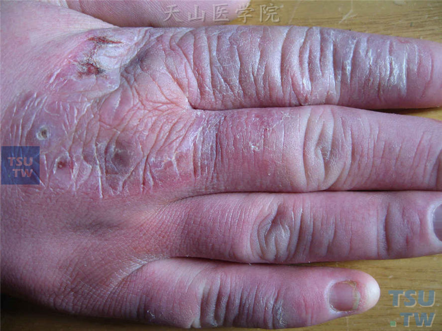 手背紫红色水肿性红斑，表面破溃、糜烂、结痂及脱屑