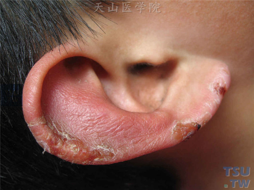 耳垂部位水肿性红斑，伴有糜烂、结痂