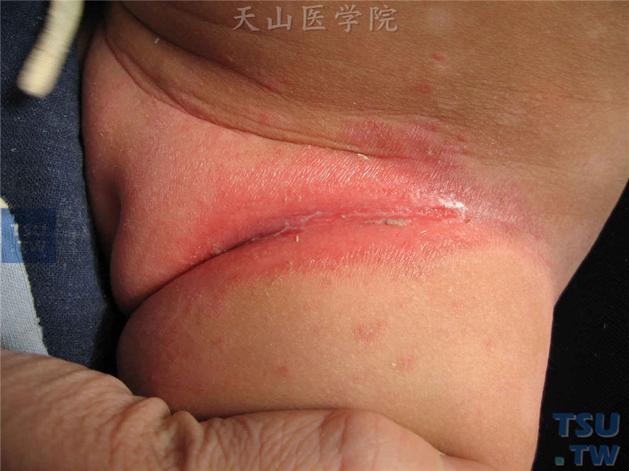 褶烂（intertrigo）摩擦红斑的症状表现