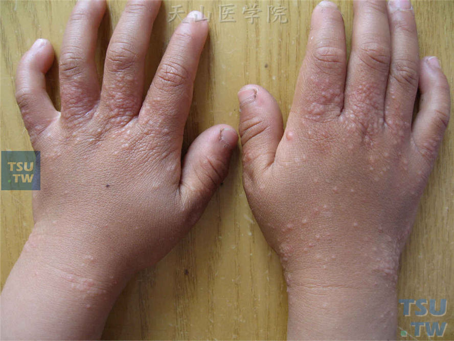 手背、手腕背侧正常皮色或淡红色圆形丘疹，中央皮损密集呈苔藓样变