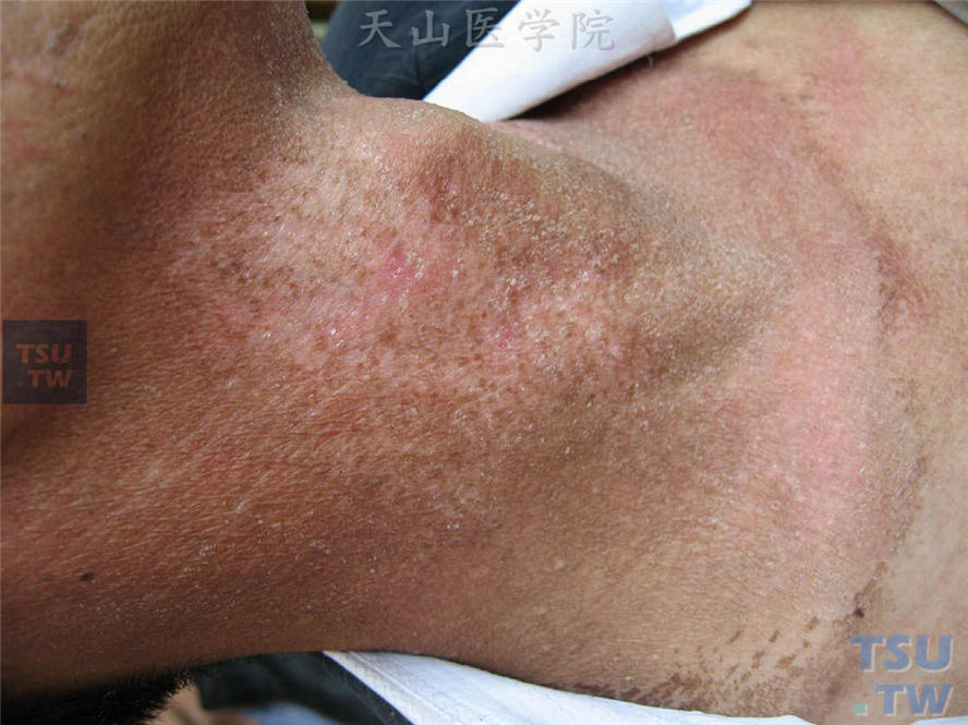 放射性皮炎（radiodermatitis）的症状表现