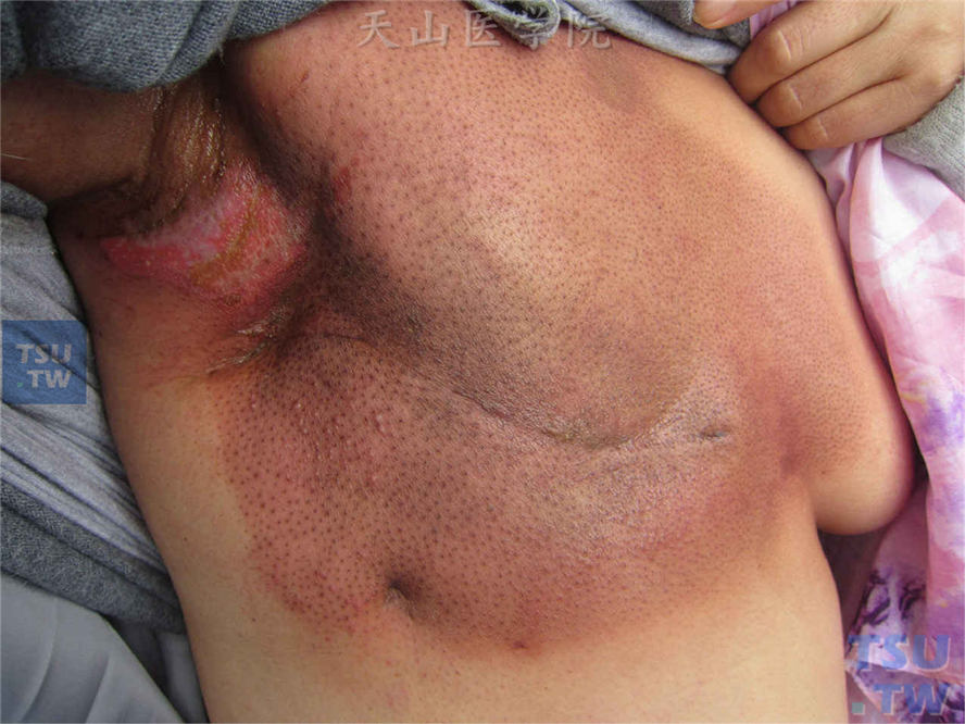 乳腺癌放疗后出现水肿性红斑，腋窝部位皮肤破溃形成糜烂面，属于急性期Ⅱ°