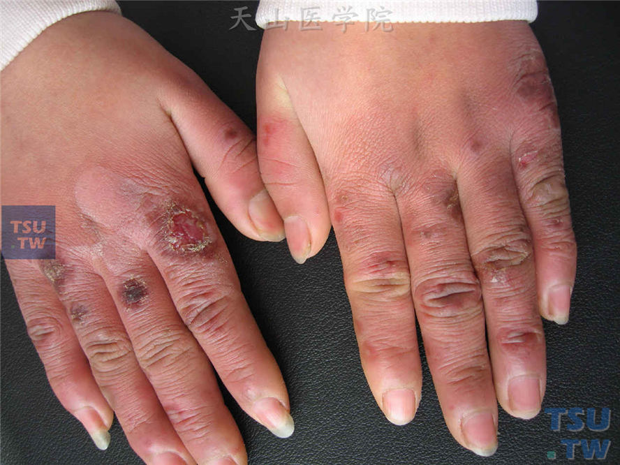 寒冷诱发的手指背侧水肿性紫红斑，中央水疱干燥、结痂