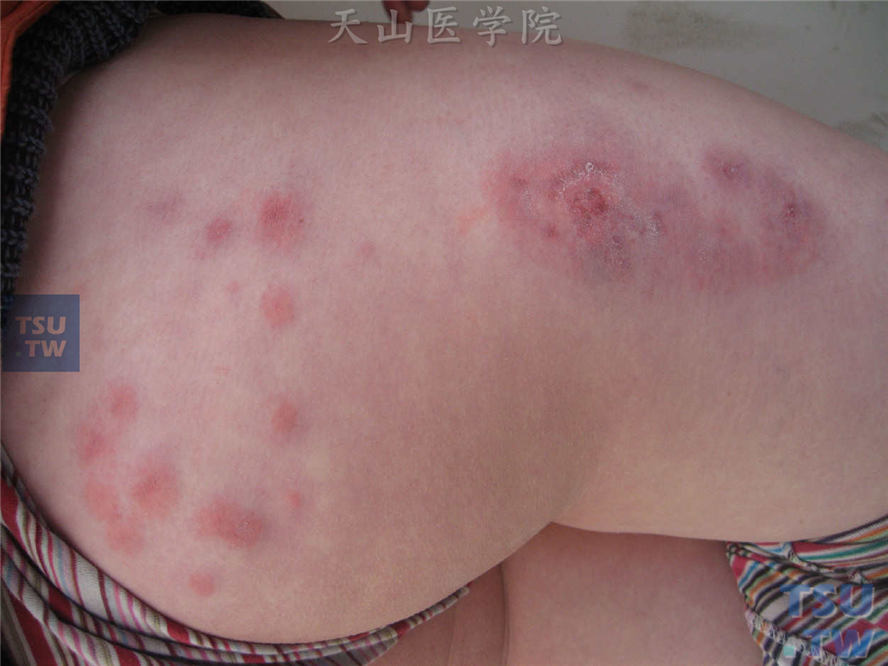 冷球蛋白血症性股臀部皮肤血管炎的症状表现