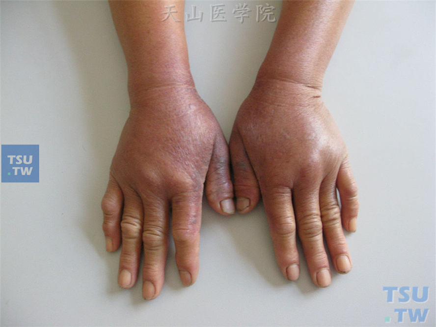 植物-日光性皮炎症状：同一病人，双手、前臂伸侧皮损