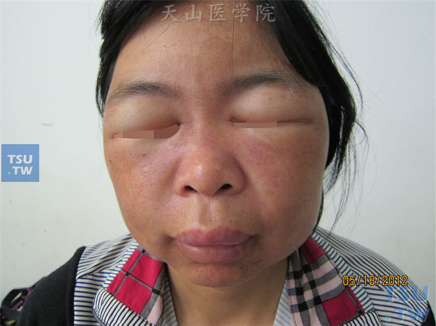 植物-日光性皮炎症状：食用野菜后发生的面部弥漫非凹陷性红肿，以双眼睑及口唇为甚