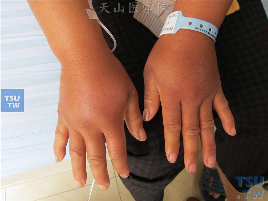 植物-日光性皮炎症状：同一病人，双手背亦表现为高度红肿