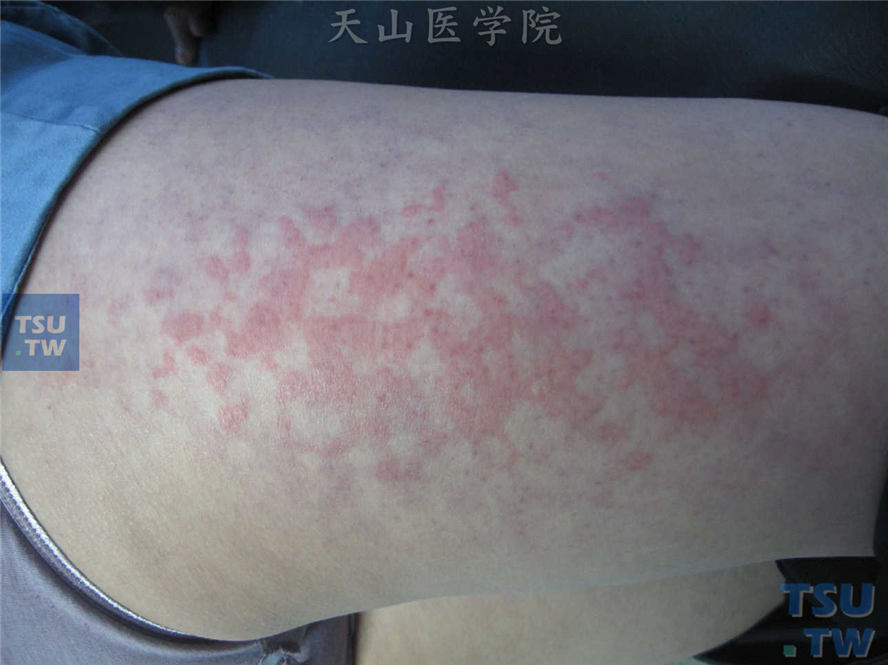 电热炉致大腿树枝状红斑