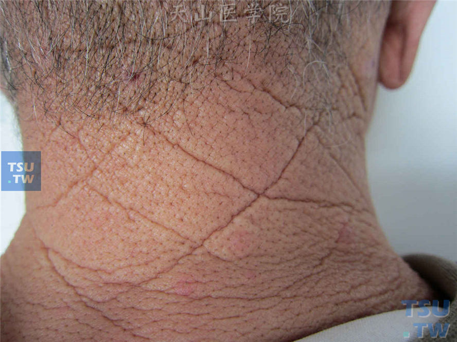 项部菱形皮肤（cutis rhomboidalis nuchae）症状表现