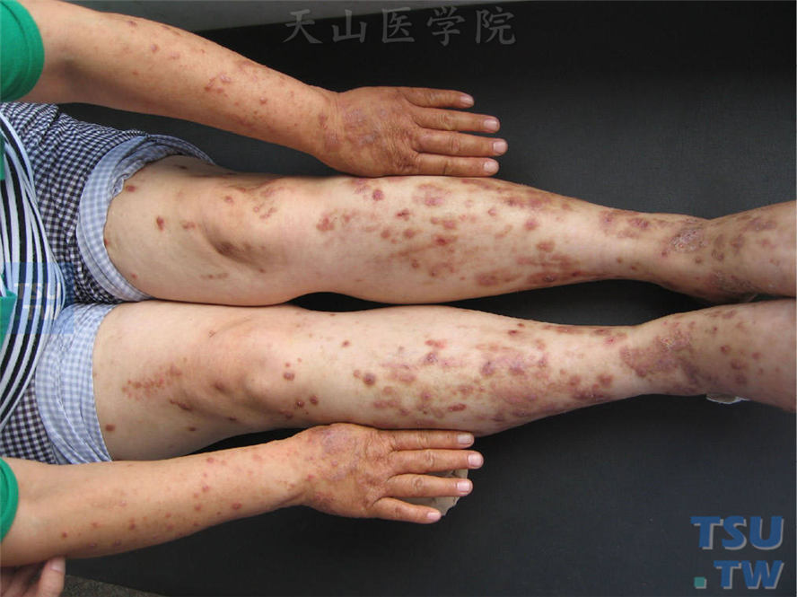 夏季外露部位发生红斑、丘疹，搔抓后发生小丘疹状痒疹样改变及抓痕
