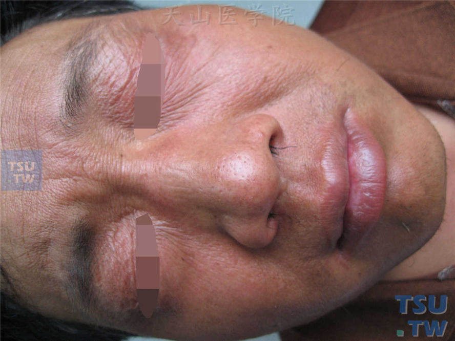 电焊工人发生的面部晒斑样反应