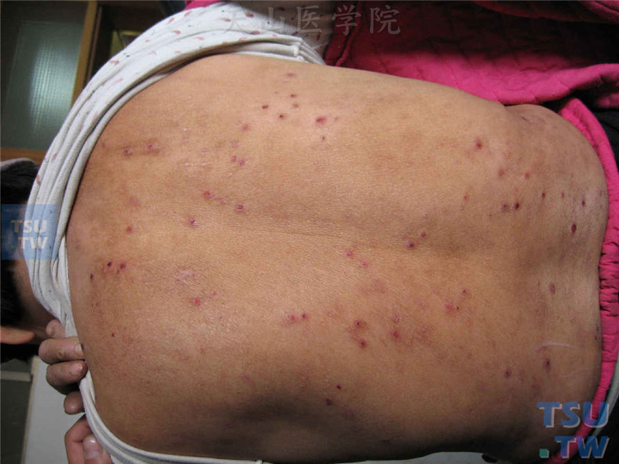 痒疹：慢性单纯性痒疹的症状表现