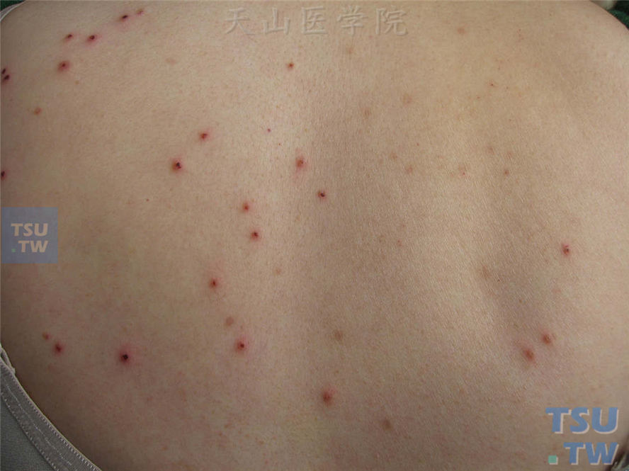 痒疹：成人急性单纯性痒疹的症状表现