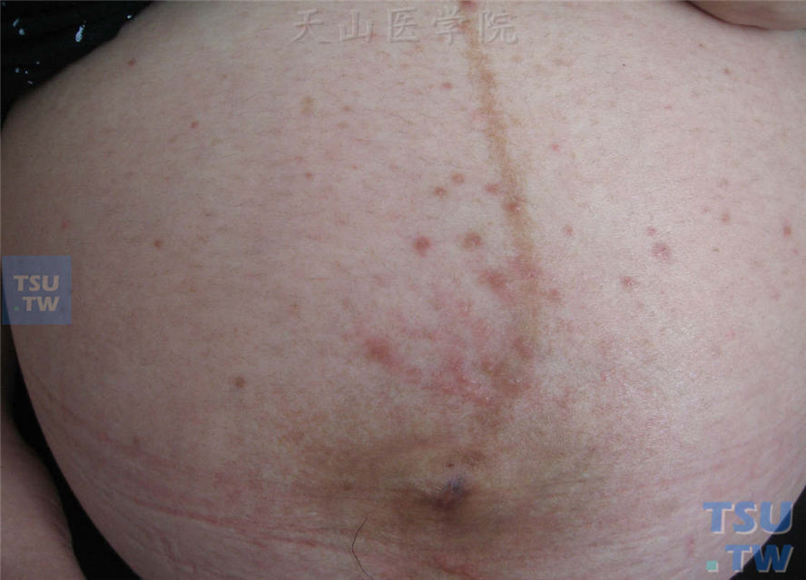 孕妇腹部散在水肿性斑丘疹，瘙痒剧烈