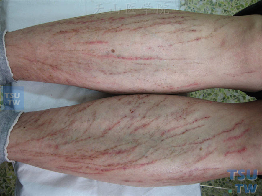 人工皮炎（dermatitis factitia）的症状表现