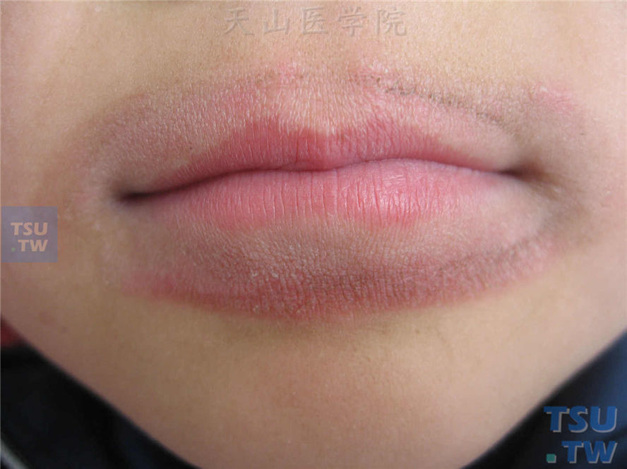 舌舐皮炎（舌头舔嘴唇引起）的症状表现