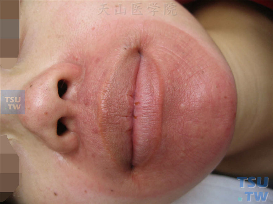 舌舔皮炎并激素依赖性皮炎：用皮炎平、恩肤霜等十几支，3个月
