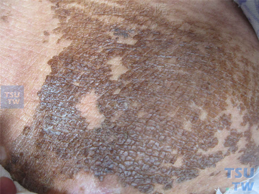 患者1年没洗澡，皮肤表面被覆褐黑色污垢干涸堆积而成的痂，脱落处为指甲刮去，基底为正常皮肤
