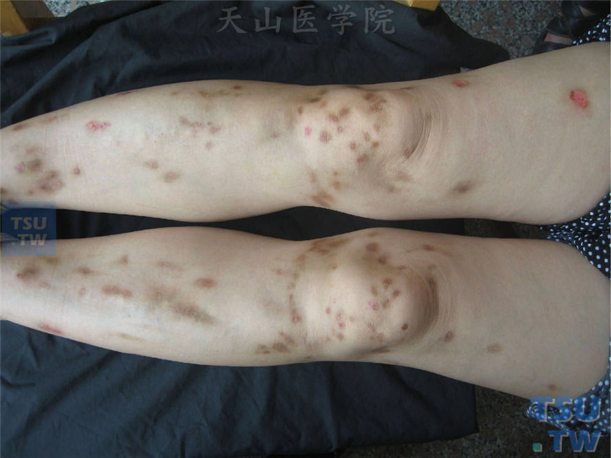 色素性痒疹（prurigo pigmentosa）的症状表现