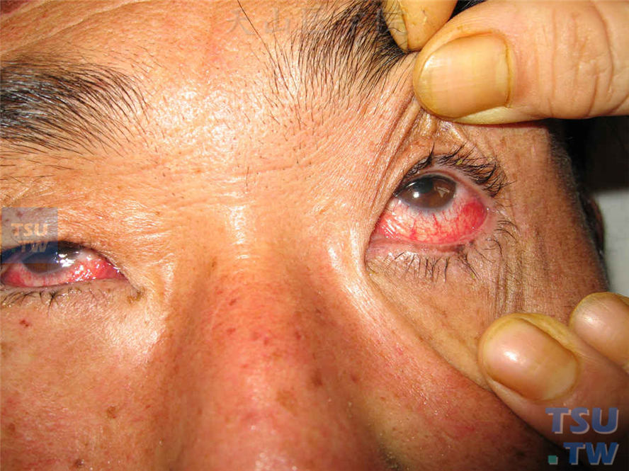 重症型多形红斑又称Stevens-Johnson综合征，全身症状严重，皮损泛发全身，累及多部位黏膜。该患者双眼眼结膜充血，睫毛粘连