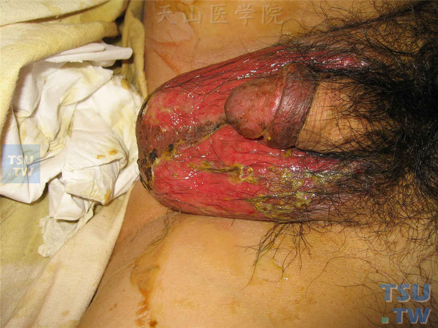 同一病人，阴囊部位鲜红色糜烂面，伴大量渗液