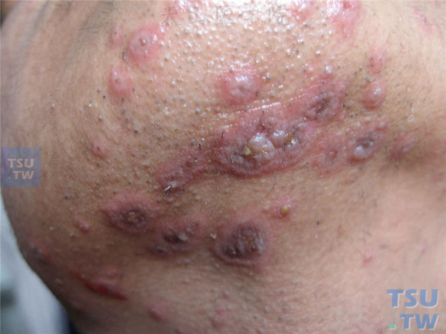 多形红斑（erythema multiforme）的症状表现