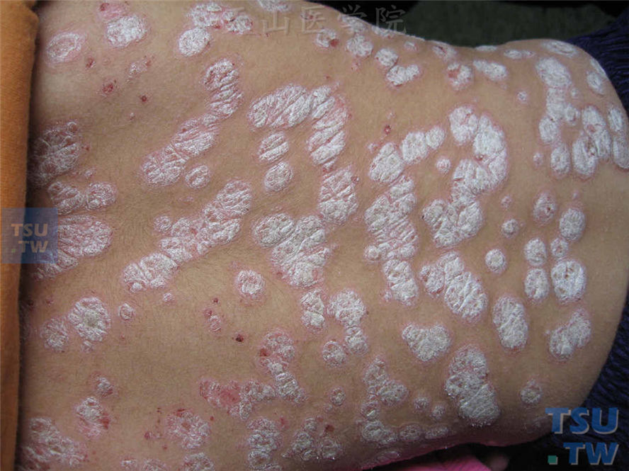 寻常型银屑病（Psoriasis Vulgaris）的症状表现