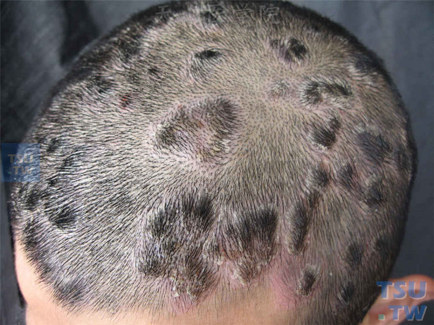寻常银屑病症状表现：头皮银屑病，表面鳞屑厚积，可见束状发