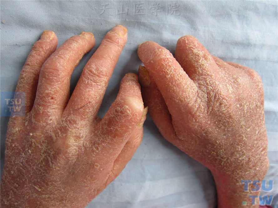手部关节屈曲变形，皮肤红斑鳞屑性损害