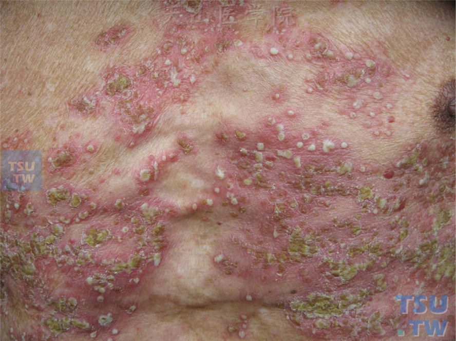 脓疱型银屑病（Psoriasis Pustulosa）的症状表现